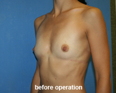 plastic-surgery-breast-augmentation